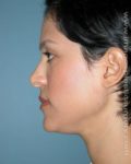 Before rhinoplasty left side view female patient case 5202