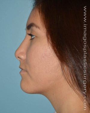 After rhinoplasty left side view female patient case 5207