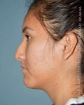 Before rhinoplasty left side view female patient case 5207