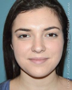 After rhinoplasty front view female patient case 5213