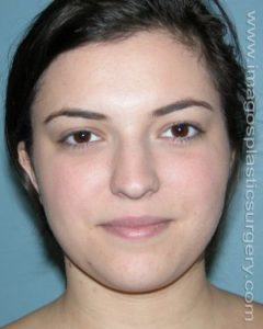 Before rhinoplasty front view female patient case 5213