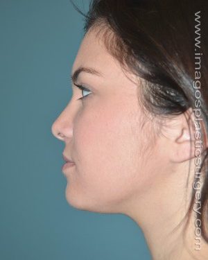 After rhinoplasty left side view female patient case 5213