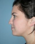 Before rhinoplasty left side view female patient case 5213