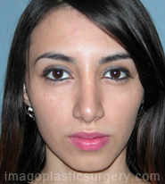 After rhinoplasty front view female patient case 5218