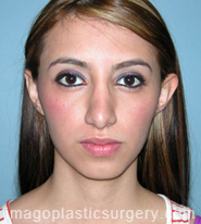 Before rhinoplasty front view female patient case 5218