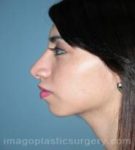 After rhinoplasty female patient left side view case 5218