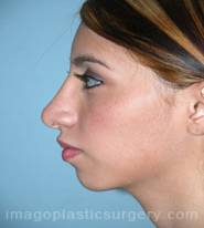 Before rhinoplasty female patient left side view case 5218