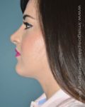 After rhinoplasty female patient left side view case 5225