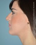 Before rhinoplasty female patient left side view case 5225
