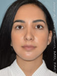 After rhinoplasty female patient front view case 5230