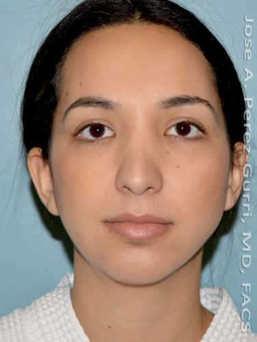 Before rhinoplasty female patient front view case 5230