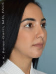 After rhinoplasty female patient right angle view case 5230