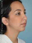 Before rhinoplasty female patient right angle view case 5230