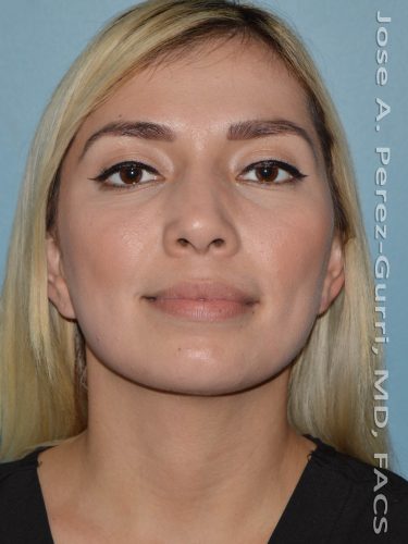 After rhinoplasty female patient front view case 5237