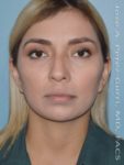 Before rhinoplasty female patient front view case 5237