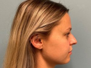 Before rhinoplasty female patient right side view case 5242