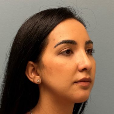 After rhinoplasty female patient right angle view case 5245