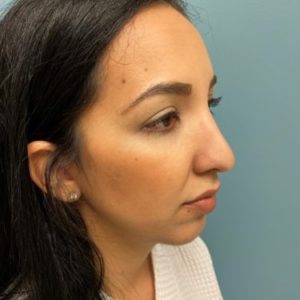 Before rhinoplasty female patient right angle view case 5245