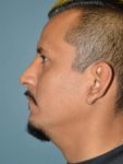After rhinoplasty male patient left side view case 5252
