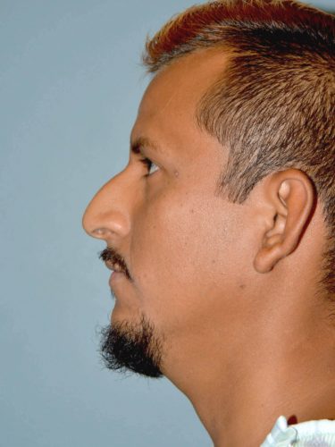 Before rhinoplasty male patient left side view case 5252