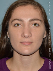 After rhinoplasty female patient front view case 5257