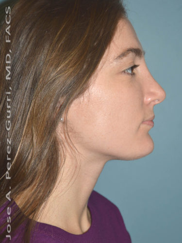 After rhinoplasty female patient right side view case 5257