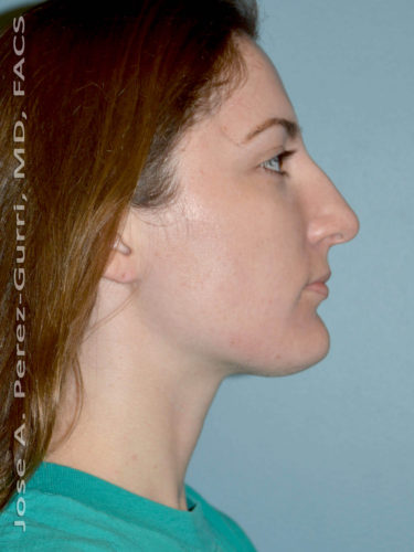 Before rhinoplasty female patient right side view case 5257