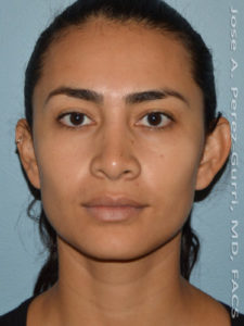 After rhinoplasty female patient front view case 5262
