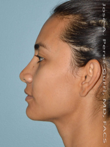 After rhinoplasty female patient left side view case 5262