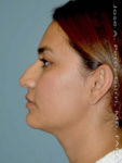Before rhinoplasty female patient left side view case 5262