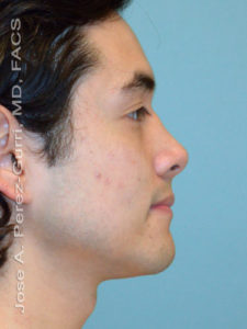 after right side view rhinoplasty of male patient 2577