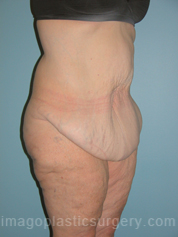 before right angle view surgery after major weight loss of female patient 2970