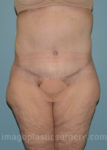 after front view surgery after major weight loss of female patient 2970