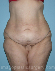 before front view surgery after major weight loss of female patient 2991
