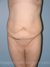 before front view surgery after major weight loss of female patient 3012