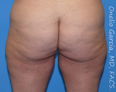 before back view thigh lift of female patient 2959