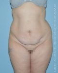 before front view tummy tuck of female patient 2689