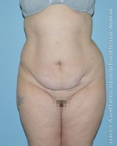 before front view tummy tuck of female patient 2689