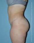 after left side view tummy tuck of female patient 2689