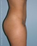 after right side view tummy tuck of female patient 2693