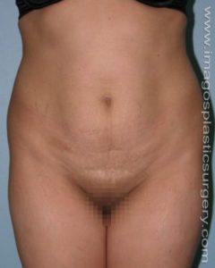 before front view tummy tuck of female patient 2699