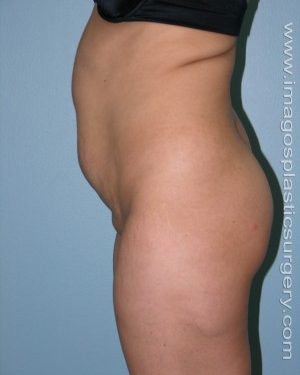 before left side view tummy tuck of female patient 2699