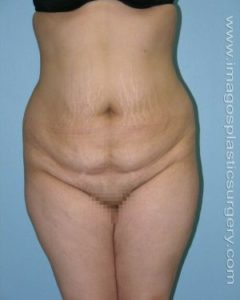 before front view tummy tuck of female patient 2707