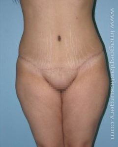 after front view tummy tuck of female patient 2707