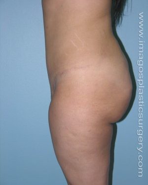 after left side view tummy tuck of female patient 2707