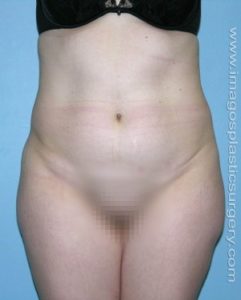 before front view tummy tuck of female patient 2713
