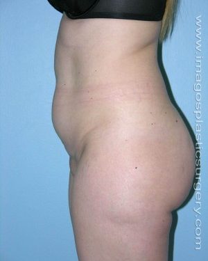 before left side view tummy tuck of female patient 2713