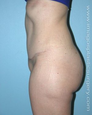 after left view tummy tuck of female patient 2713