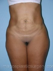 before front view tummy tuck of female patient 2718