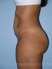 before left side view tummy tuck of female patient 2718